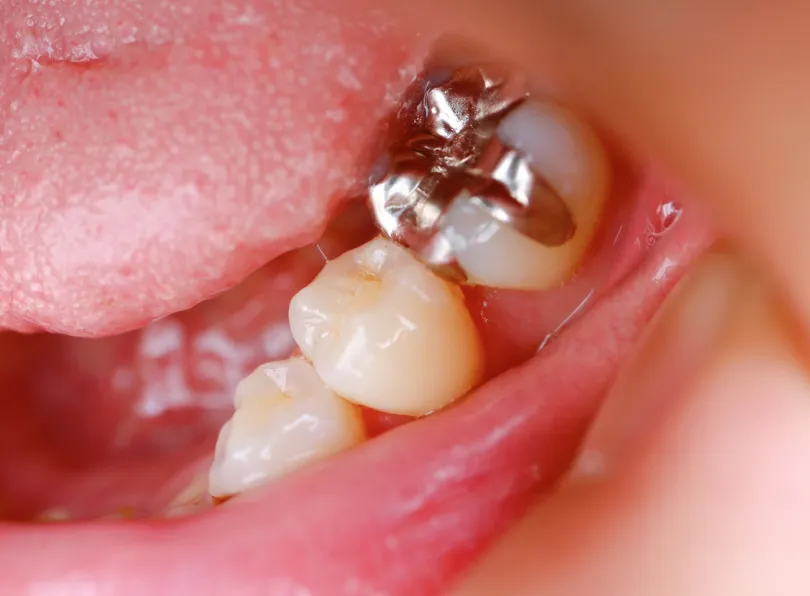 かぶせ物を装着